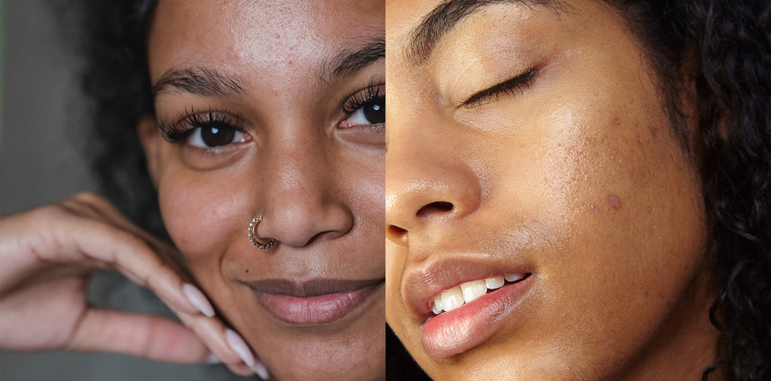 Fading Dark Spots & Hyperpigmentation with Azelaic Acid